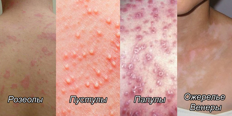 Какая бывает сыпь при сифилисе? Первые симптомы и проявления на коже, характерные высыпания при вторичной форме, а также отличие от обычных прыщей и тактика лечения