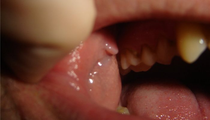 Почему возникают и как лечатся кондиломы во рту? Советы профессионалов