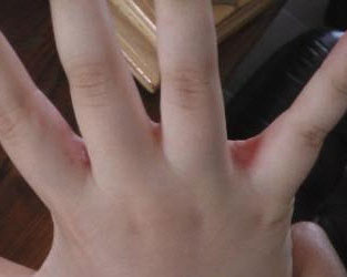 Причины покраснения между пальцами рук
