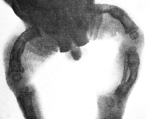 Фото рентгенограммы больного с тяжелой формой несовершенного остеогенеза: деформация нижних конечностей