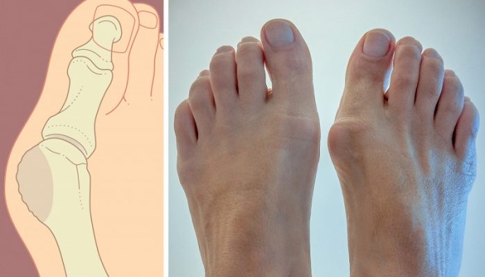 Почему возникает шишка на ноге? Симптомы и лечение распространенной проблемы