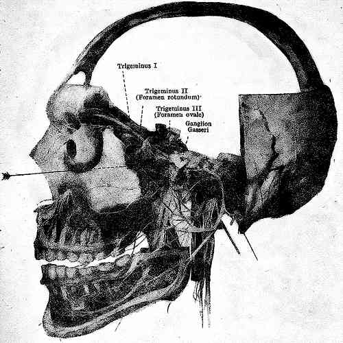 Орбитальная блокада n. maxillaris в foramen rotundum