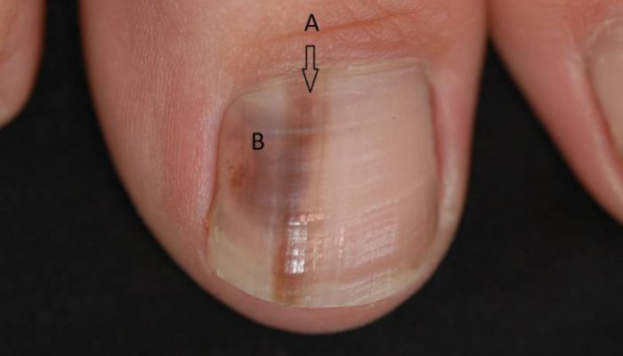 Симптомы и лечение меланомы ногтя