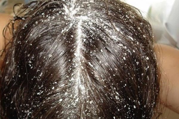Массаж для роста волос на голове: как выполнять?
