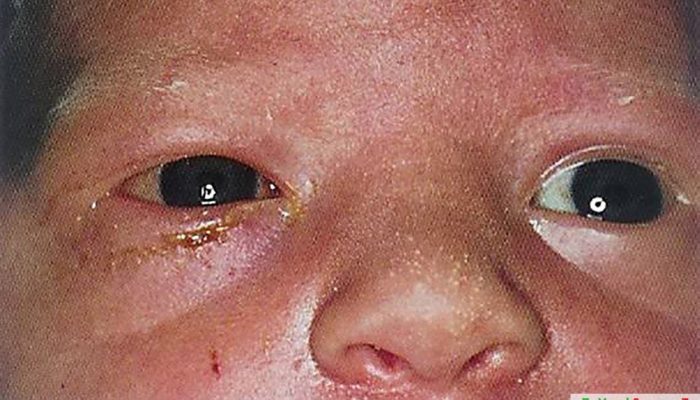 Симптомы и лечение хламидиоза у детей