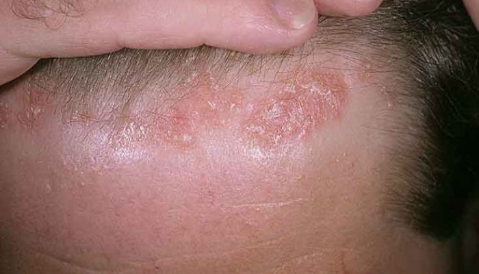 Себорейный сухой дерматит на голове: лечение