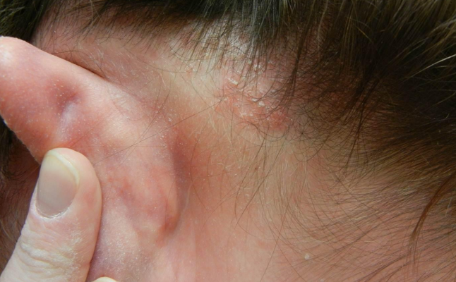 Псориаз за ушами и в ухе: симптомы и лечение