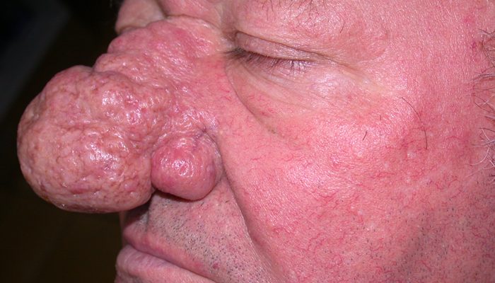 Что такое ринофима носа?