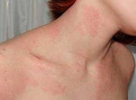 Как проявляется аллергия на коже