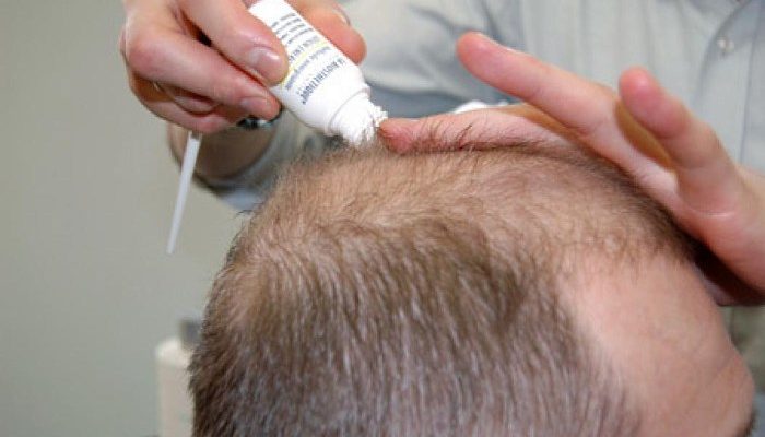 Выпадение волос при себорейном дерматите