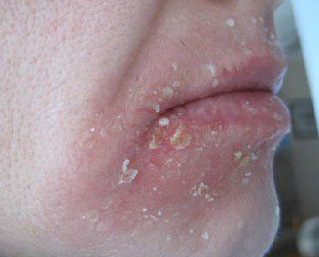 Почему шелушится и сохнет кожа вокруг рта на лице
