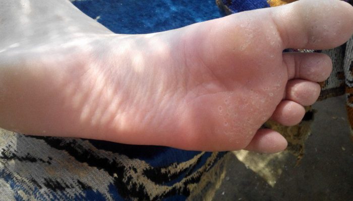 Почему появляются дырочки на ступнях ног? Симптомы и методы лечения