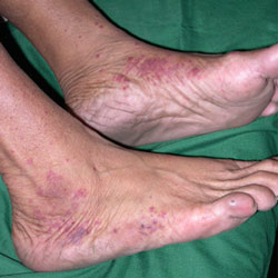 На стопе ноги появляются красные пятна, в следствии развития сахарного диабета