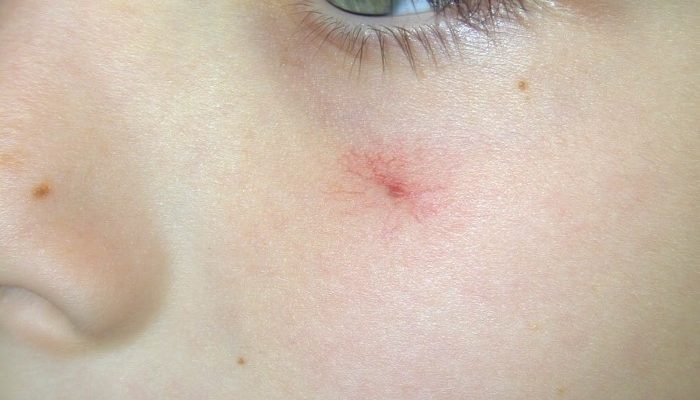 Почему появляются красные точки на лице? Причины проблемы и методы лечения