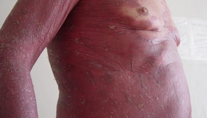 Эритродермический псориаз: симптомы и лечение