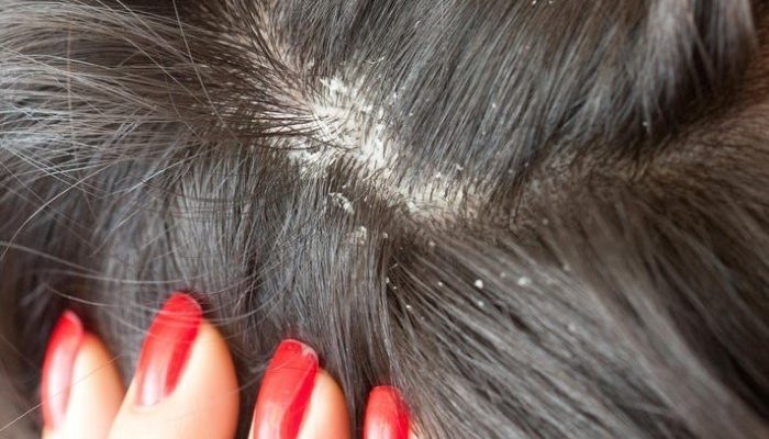 Выпадение волос при себорейном дерматите