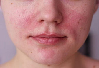 Аллергическая сыпь возле носа thumbnail