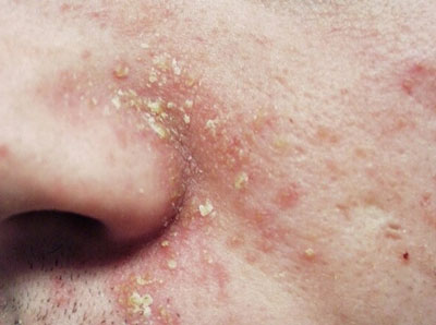 Аллергия на лице вокруг носа thumbnail