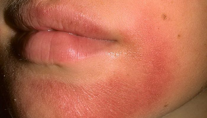 Как выглядит и лечится дерматит на лице? Полезные советы