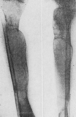 Болезнь Реклингхаузена. Большеберцовая кость перестроена: резко и неравномерно утолщена, выполнена громадными китовидными полостями, кортикальный слой резко истончен.