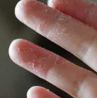 Почему слезает кожа на пальцах рук