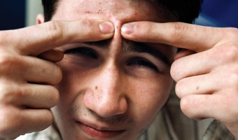 лечение угрей на лице у мальчиков и подростков