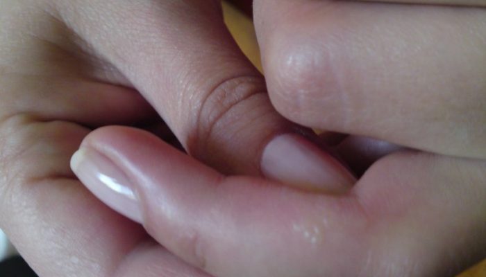 Почему чешется между пальцев рук? Способы лечения покраснения и шелушения