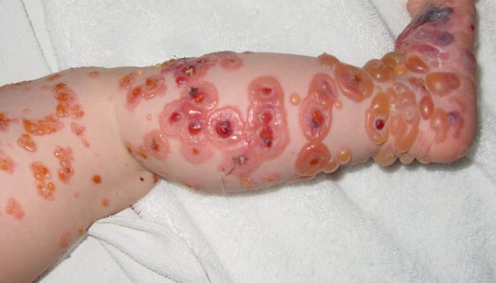 Что такое буллезный дерматит? Причины возникновения пузырьковых высыпаний на коже и методы лечения булл