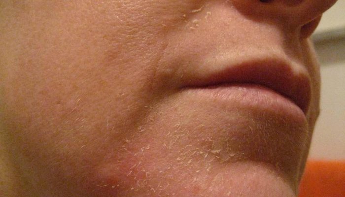 Что делать, если шелушится кожа на лице? Традиционные средства и эффективные народные рецепты