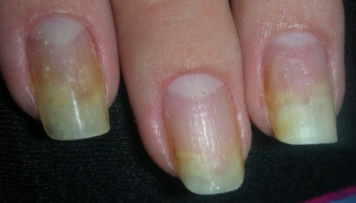Как лечить онихолизис ногтей на руках?
