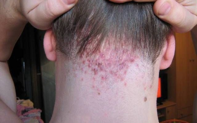 Разбираем распространенные заболевания кожи головы у детей и взрослых, а также методы их лечения