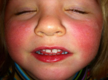 Пунцовые щеки у ребенка и температура thumbnail