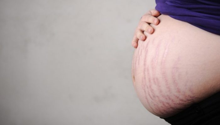 Крем от растяжек при беременности Avent: простая и эффективная профилактика