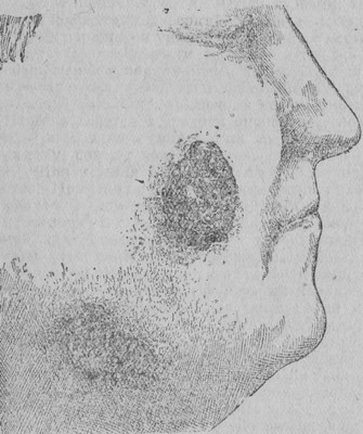 Кожный лейшманиоз (Гессе Э.Р., 1934 год)