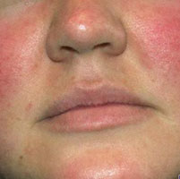 Покраснение кожи лица вокруг носа при гайморите thumbnail