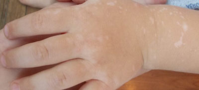 Появились белые пятнышки на коже рук в руки thumbnail