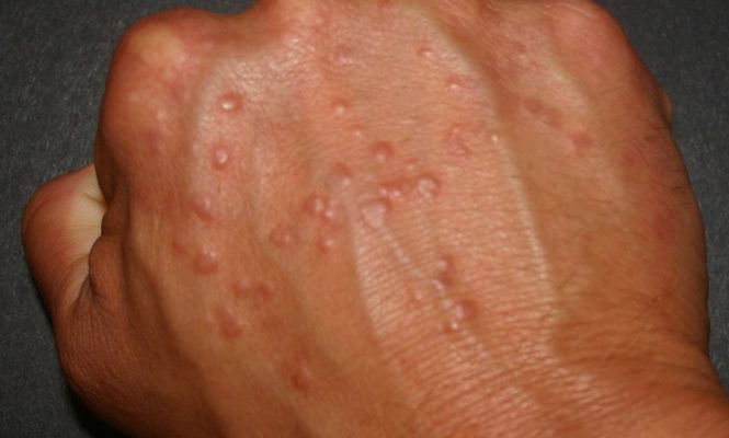 Пылевые клещи: симптомы аллергии на коже