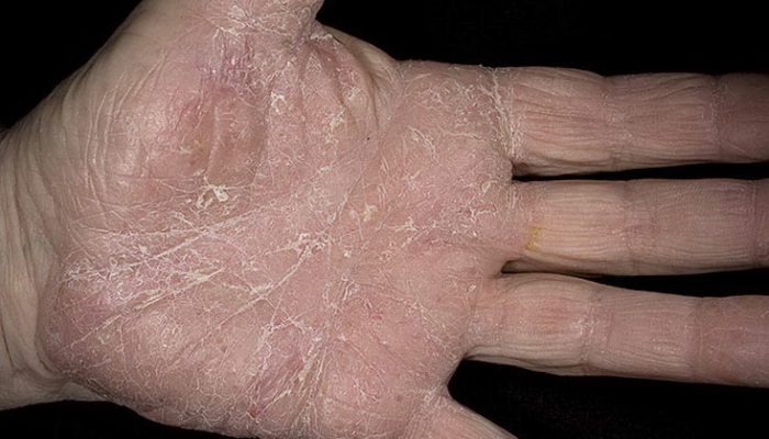 Кератоз кожи: симптомы и лечение