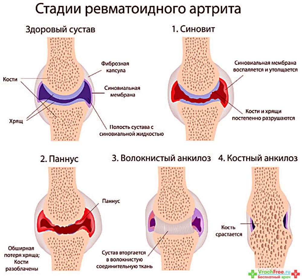 Паннус ревматоидный артрит