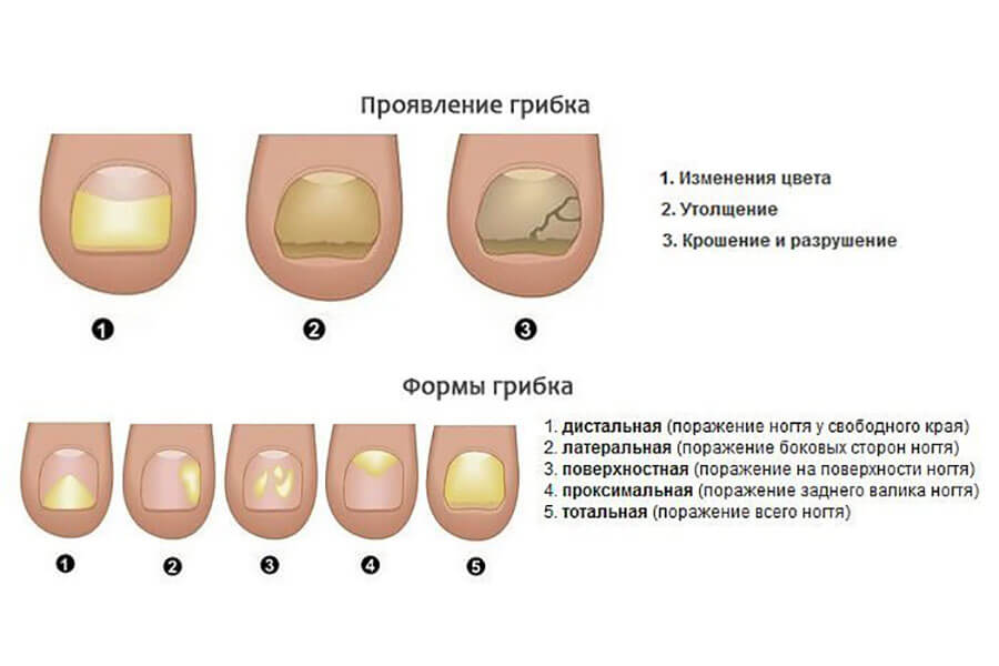 Грибок ногтей: симптомы, методы лечения
