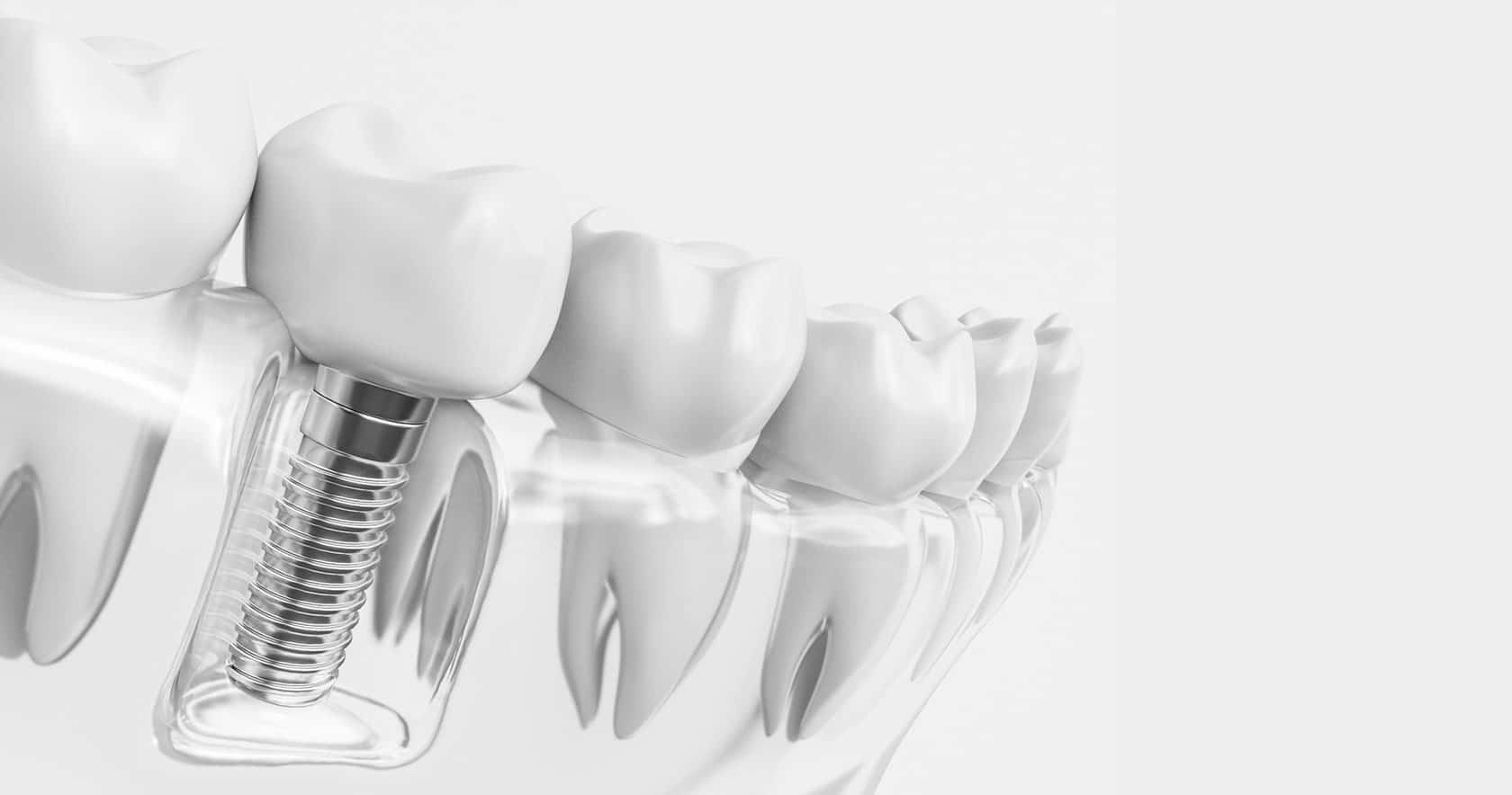 Имплантация зубов: какой она бывает и кому подходит