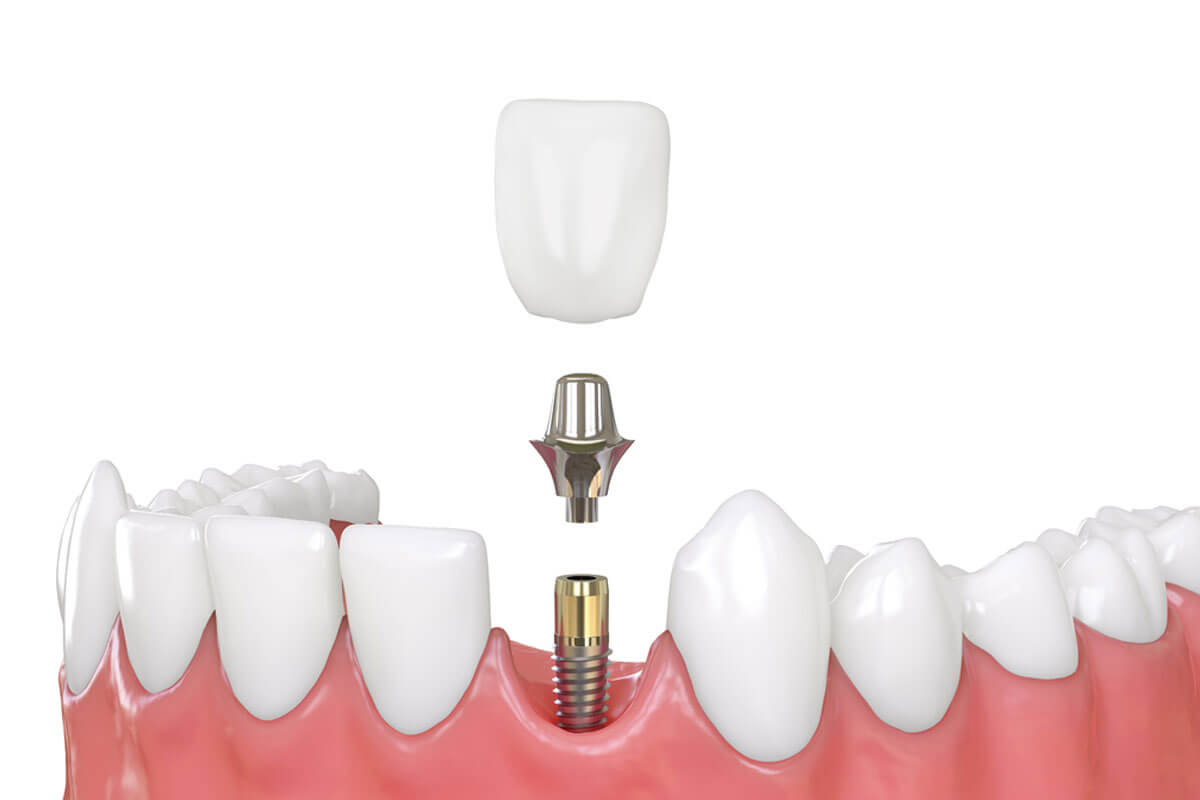Импланты как родные зубы