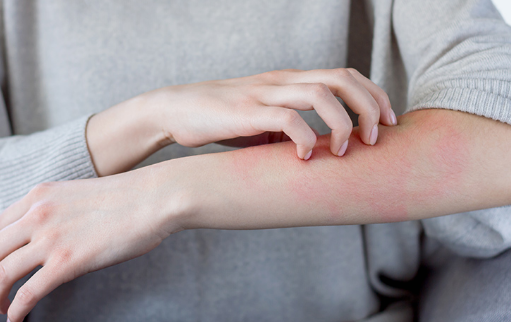 Как аллергия влияет на здоровье и жизнь: виды, симптомы, диагностика